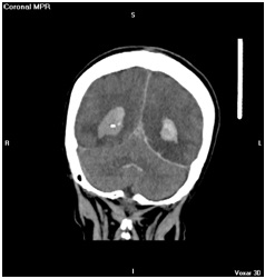 aneurisma_cerebral_roto/Hemorragia_intraventricular_supra