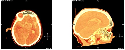 aneurisma_cerebral_roto/MPR3D_mismo_paciente