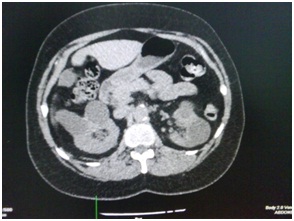 aneurisma_cerebral_roto/TAC_abdominal_corte_axial