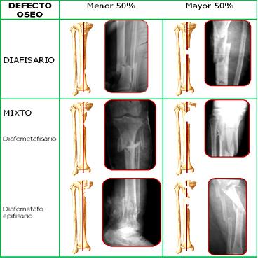 defectos_oseos_fracturas/defecto_oseo defectos_oseos_fracturas/defecto_oseo