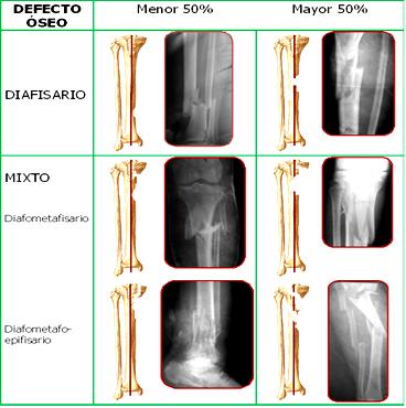 defectos_oseos_fracturas/defecto_oseo