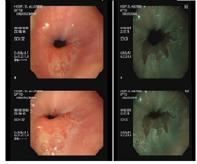 diagnostico_endoscopico_Barret/foto2_endoscopia_diagnostico_EB