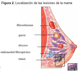 diagnostico_lesiones_mamografias/localizacion_lesiones_mama