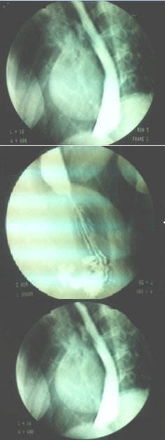 disfagia_esclerodermia_mujer/transito_esofago-gastro-duodenal