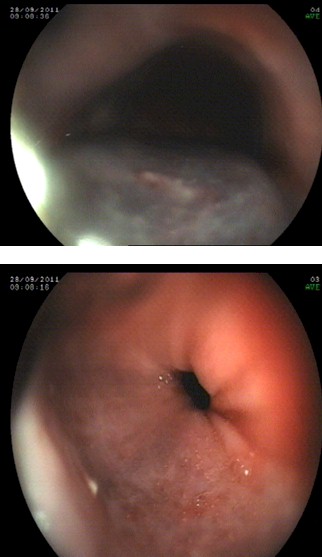 hematoma_esofagico_antiagregacion/lesiones_endoscopicas_endoscopia hematoma_esofagico_antiagregacion/lesiones_endoscopicas_endoscopia