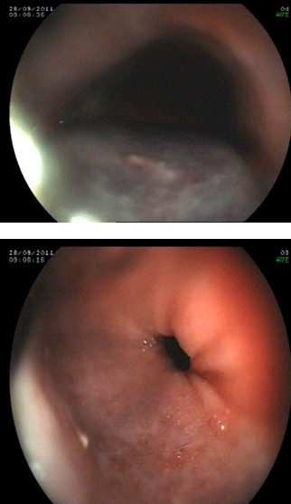 hematoma_esofagico_antiagregacion/lesiones_endoscopicas_endoscopia