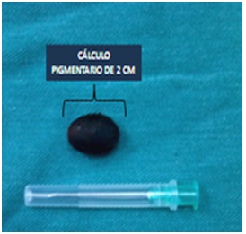 litiasis_coledociana_primaria/calculo_pigmentario litiasis_coledociana_primaria/calculo_pigmentario