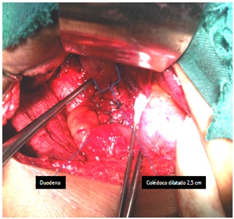 litiasis_coledociana_primaria/cirugia_coledoco_dilatado