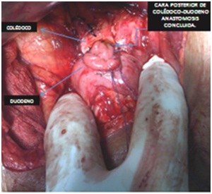 litiasis_coledociana_primaria/coledoco_anastomosis_concluida litiasis_coledociana_primaria/coledoco_anastomosis_concluida