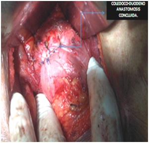 litiasis_coledociana_primaria/coledoco_anastomosis_concluida