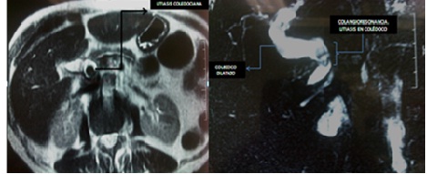 litiasis_coledociana_primaria/laparotomia_biliar litiasis_coledociana_primaria/laparotomia_biliar