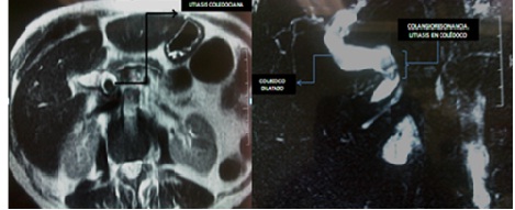 litiasis_coledociana_primaria/laparotomia_biliar