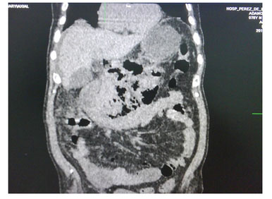 pancreatitis_necrotizante_caso/figura_cuatro_necrosis