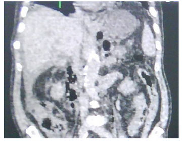 pancreatitis_necrotizante_caso/figura_dos_visualizacion pancreatitis_necrotizante_caso/figura_dos_visualizacion