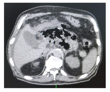 pancreatitis_necrotizante_caso/figura_tres_hemiabdomen