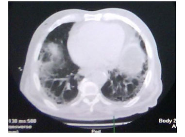 pancreatitis_necrotizante_caso/figura_uno_axial