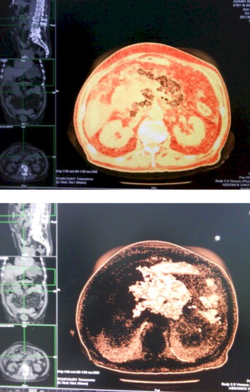 pancreatitis_necrotizante_caso/figuras_gas_3D pancreatitis_necrotizante_caso/figuras_gas_3D