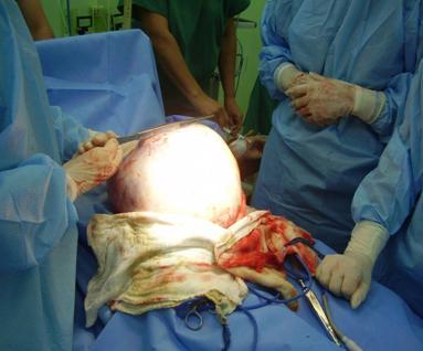 quiste_ovario_gigante/intervencion_quirurgica_tumor
