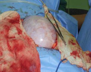 quiste_ovario_gigante/tumor_quistico_laparotomia quiste_ovario_gigante/tumor_quistico_laparotomia
