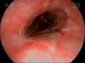 sindrome_constitucional_joven/esofagitis_peptica_grado_C sindrome_constitucional_joven/esofagitis_peptica_grado_C