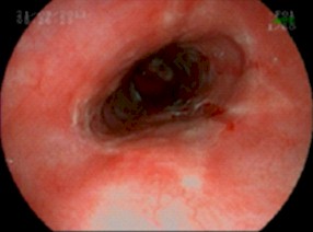 sindrome_constitucional_joven/esofagitis_peptica_grado_C