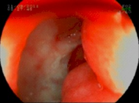sindrome_constitucional_joven/ulcera_duodenal_Forrest_III sindrome_constitucional_joven/ulcera_duodenal_Forrest_III