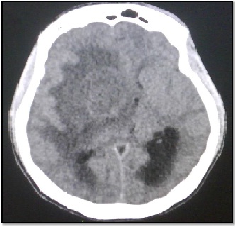 tumor_fantasma_SIDA/Fig.1_Lesion_nodular_hipodensa