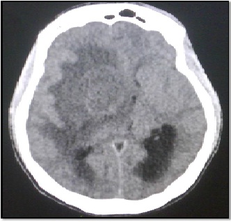 tumor_fantasma_SIDA/Fig.1_Lesion_nodular_hipodensa tumor_fantasma_SIDA/Fig.1_Lesion_nodular_hipodensa