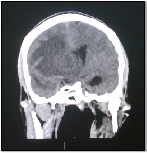 tumor_fantasma_SIDA/Fig.2_desplazamiento_linea_media tumor_fantasma_SIDA/Fig.2_desplazamiento_linea_media