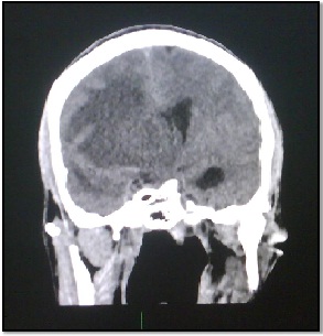 tumor_fantasma_SIDA/Fig.2_desplazamiento_linea_media