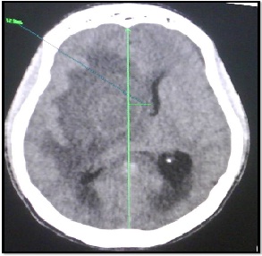 tumor_fantasma_SIDA/Fig.3_herniacion_cerebral