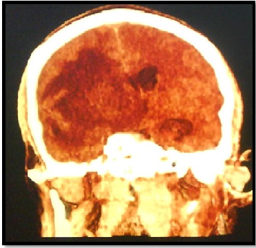 tumor_fantasma_SIDA/Fig.4_lesion_3D tumor_fantasma_SIDA/Fig.4_lesion_3D