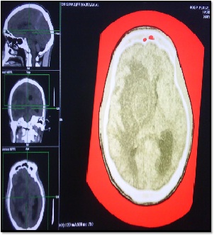 tumor_fantasma_SIDA/Fig.4_lesion_contraste