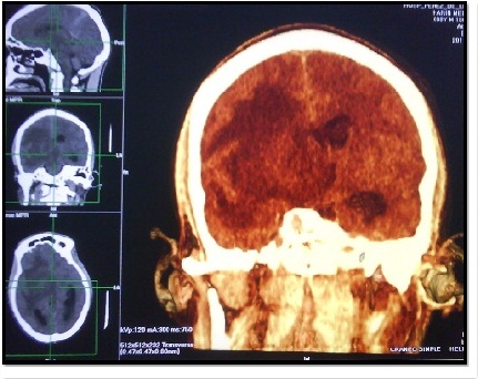tumor_fantasma_SIDA/Fig.5_realce_edema tumor_fantasma_SIDA/Fig.5_realce_edema