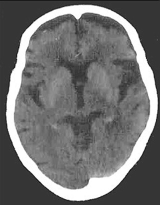 afasia_caso_clinico/TAC_tomografia_axial