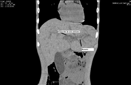 ascaris_via_biliar/caso1_ascaris