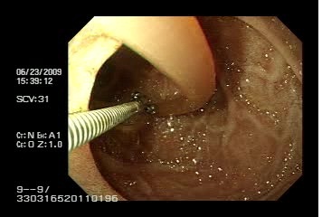 ascaris_via_biliar/caso1_endoscopia