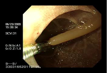 ascaris_via_biliar/caso1_endoscopia_ascaris