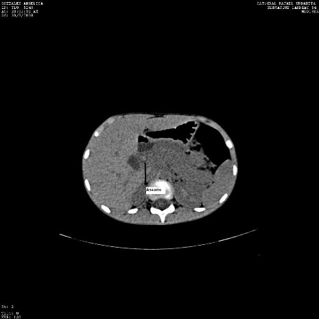 ascaris_via_biliar/caso2_TAC_ascaris ascaris_via_biliar/caso2_TAC_ascaris