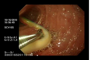 ascaris_via_biliar/caso2_endoscopia ascaris_via_biliar/caso2_endoscopia