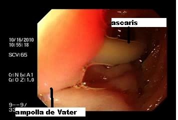 ascaris_via_biliar/caso2_endoscopia_ascaris
