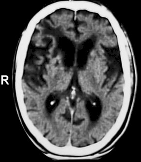 deterioro_cognitivo_familia/TAC_craneal_demencia