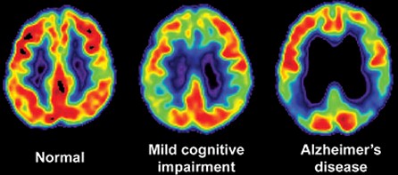 deterioro_cognitivo_familia/enfermedad_Alzheimer_demencia