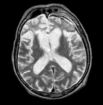 enfermedad_Pick_demencia/atrofia_lobulo_frontal enfermedad_Pick_demencia/atrofia_lobulo_frontal