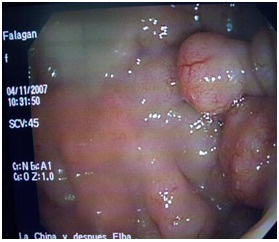 laparoscopia_diagnostico_digestivo/imagen_endoscopica_poliposis