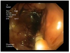 laparoscopia_diagnostico_digestivo/metastasis_hepaticas