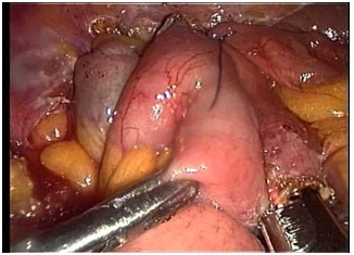 laparoscopia_diagnostico_digestivo/tumor_intestino_delgado