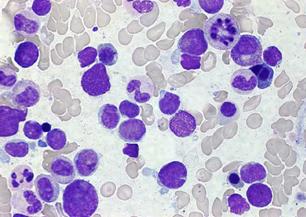leucemia_celulas_dendriticas/celulas_blasticas_dendriticas leucemia_celulas_dendriticas/celulas_blasticas_dendriticas
