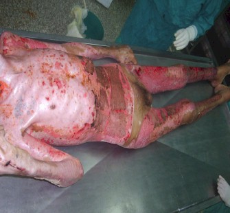 mortalidad_quemaduras_quemados/paciente_critico_5 mortalidad_quemaduras_quemados/paciente_critico_5