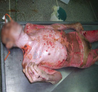 mortalidad_quemaduras_quemados/paciente_critico_6 mortalidad_quemaduras_quemados/paciente_critico_6